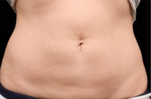 CoolSculpting results after 8 weeks