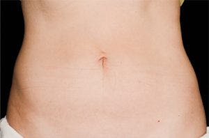 CoolSculpting results after 9 weeks