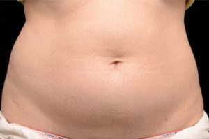 Patient stomach before CoolSculpting