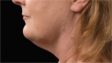 chin-after Female chin 12 weeks after CoolSculpting