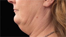 chin-before Female chin before CoolSculpting