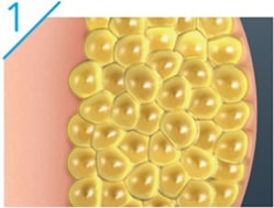 CoolSculpting Diagram 1 - stubborn fat diagram