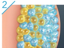 CoolSculpting Diagram 2 - use cooling to target stubborn fat