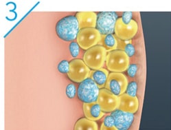 CoolSculpting diagram 3