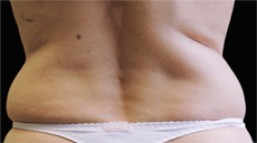 flanks-before Flanks before CoolSculpting