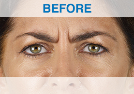 Example 2: Xeomin results - before