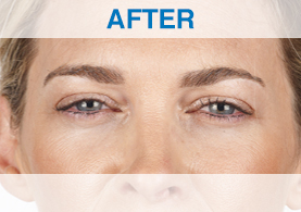 Example 1: Xeomin Results - after