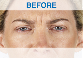 Example 1: Xeomin Results - before