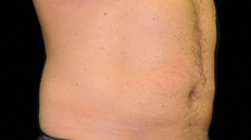 male-abdomen-after Male abdomen 16 weeks after CoolSculpting