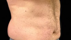 male-abdomen-before Male abdomen before Coolsculpting