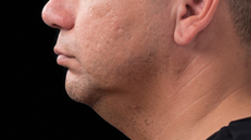male-chin-after Male chin after 12 weeks after CoolSculpting