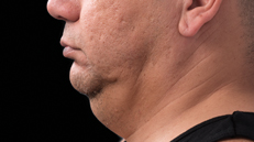 male-chin-before Male chin before CoolSculpting